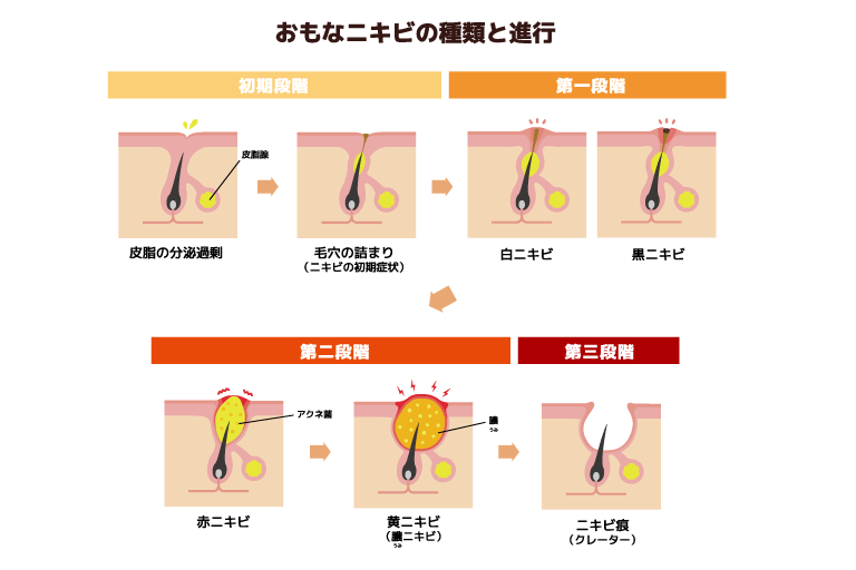 メンズスキンケアの大敵 ニキビ跡の原因と対策方法を紹介 Snob スノッブ